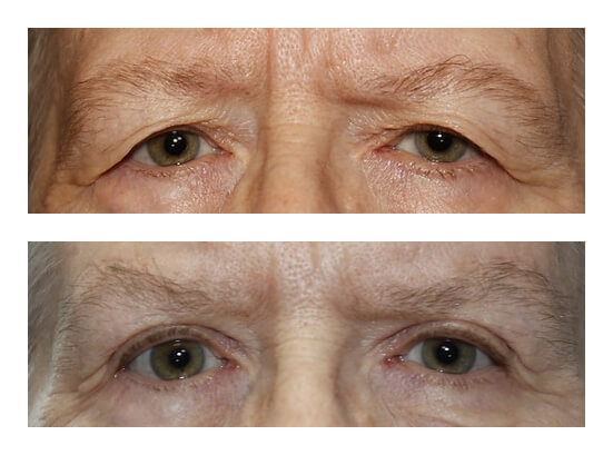 Before and after pics of a Upper Blepheroplasty patient