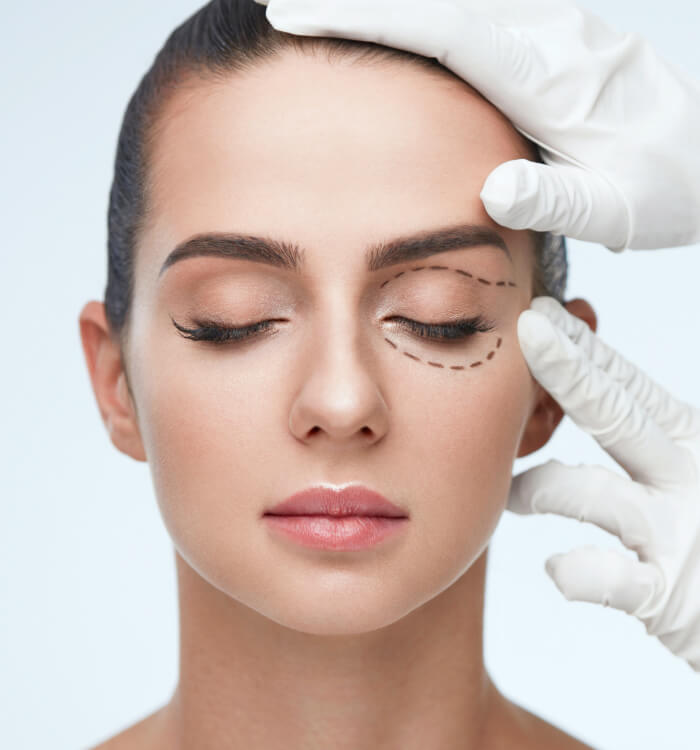 Front view of face of a model girl with one of her eye being marked before surgery