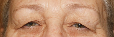 Before pic of eyes of a Upper Blepheroplasty patient