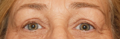 After pic of eyes of a Upper Blepheroplasty patient