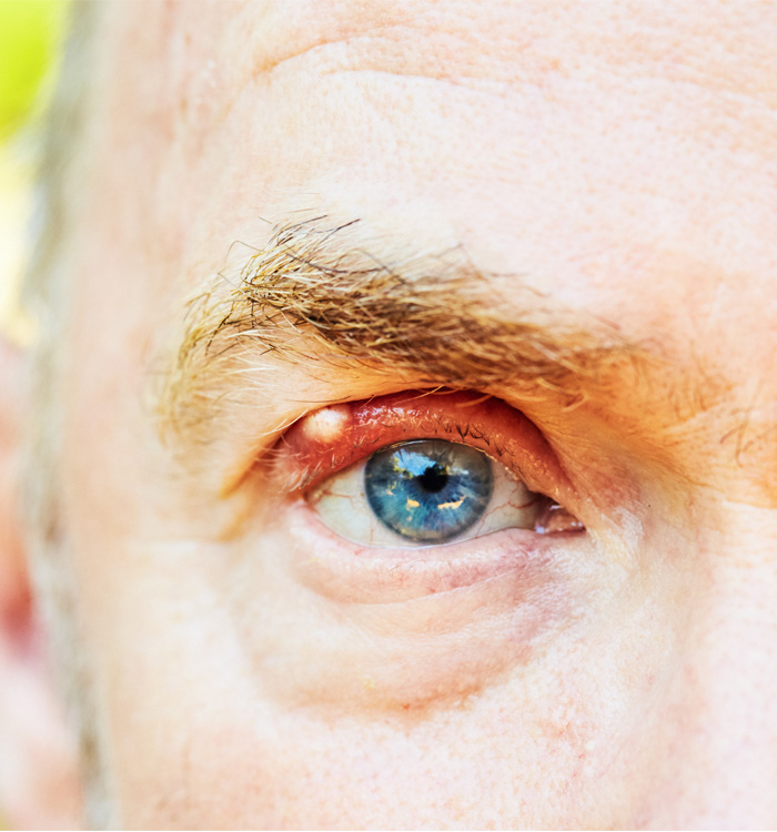 Picture of a man's eye affected with cancer