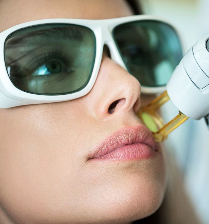 Laser treatment being done on upper lips of an woman wearing white framed glasses