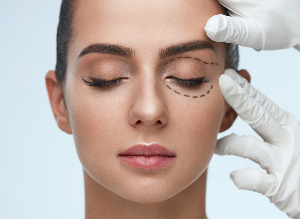 Front view of face of a model girl with one of her eye being marked before surgery